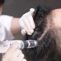 بررسی روش مزوتراپی مو با دستگاه